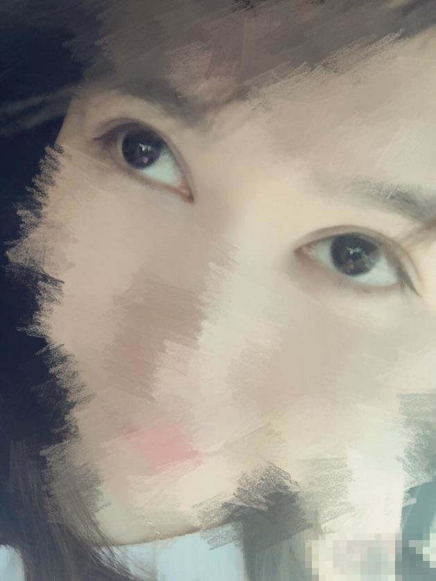 两次做双眼皮的经验