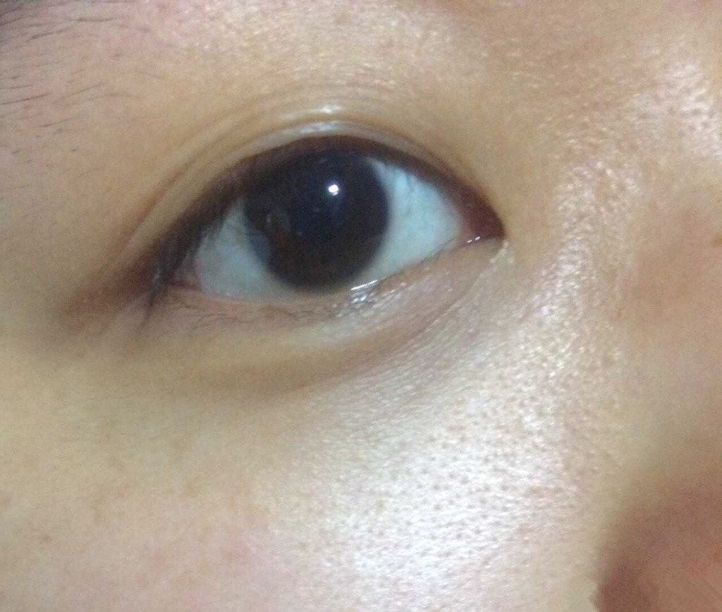 T区和鼻翼两侧有像鸡皮一样的东西，这是什么，该怎么去掉？