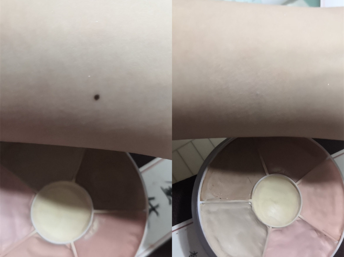 有没有可以遮痣的遮瑕膏，什么遮瑕膏遮痣效果好