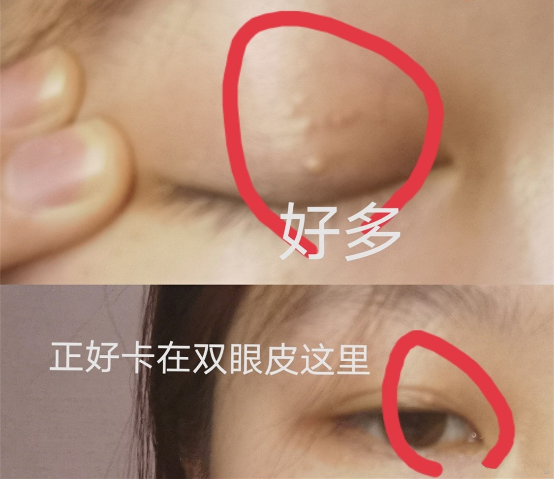 上眼皮长了脂肪粒怎么办啊