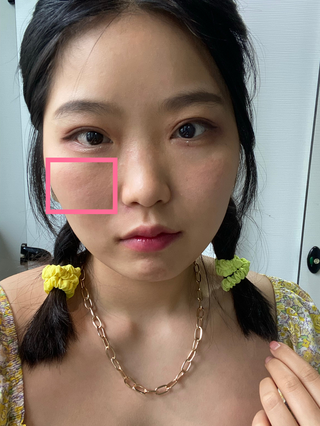 颧骨下方有一条凹陷的坑